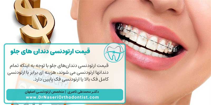 قیمت ارتودنسی دندان های جلو | دکتر محمدعلی ناصری متخصص ارتودنسی اصفهان