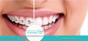 ارتودنسی دندان چیست؟