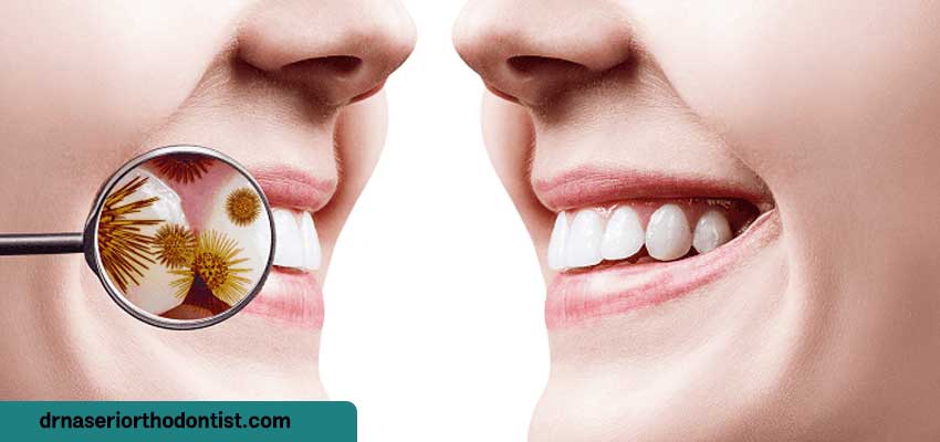 عوارض عدم درمان عفونت دندان حین ارتودنسی