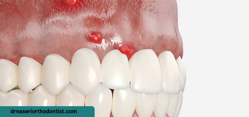 آیا عفونت دندان پس از درمان ارتودنسی به‌خودی‌خود رفع می‌شود؟