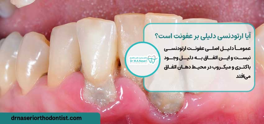 آیا ارتودنسی دلیلی بر عفونت دندان است؟