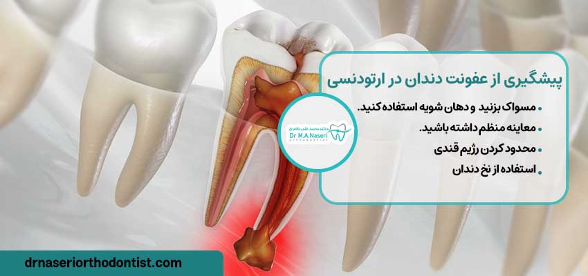 روش های پیشگیری از عفونت دندان در ارتودنسی 