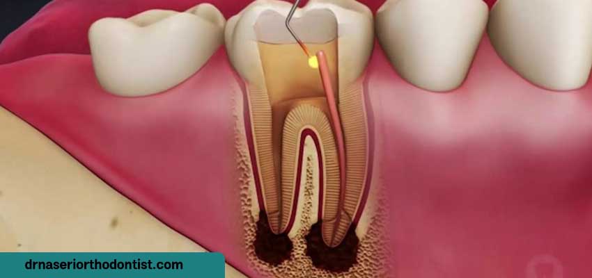 علائم و نشانه های عفونت دندان و التهاب لثه
