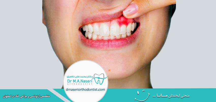 عفونت دندان در حین ارتودنسی