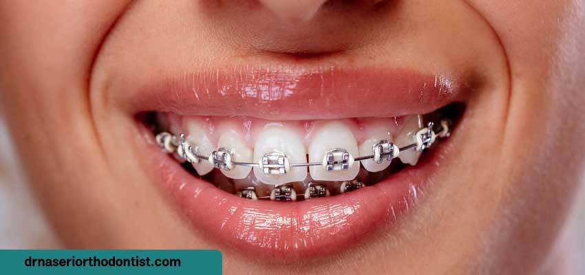 چه زمانی حرکت دندان‌ها پس از ارتودنسی نگران‌ کننده است؟