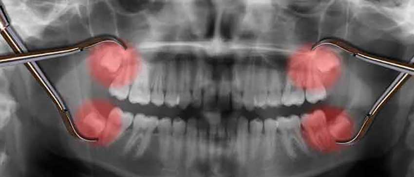 کشیدن دندان عقل و ارتودنسی