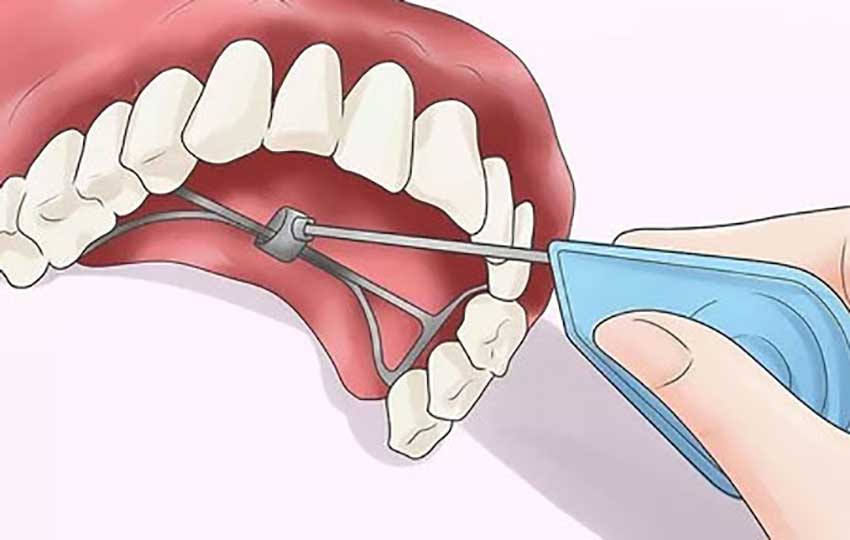 ردیف کردن دندان ها بدون ارتودنسی