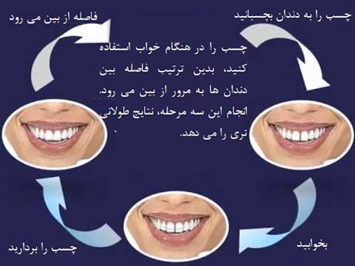 از بین بردن فاصله بین دندان ها بدون ارتودنسی
