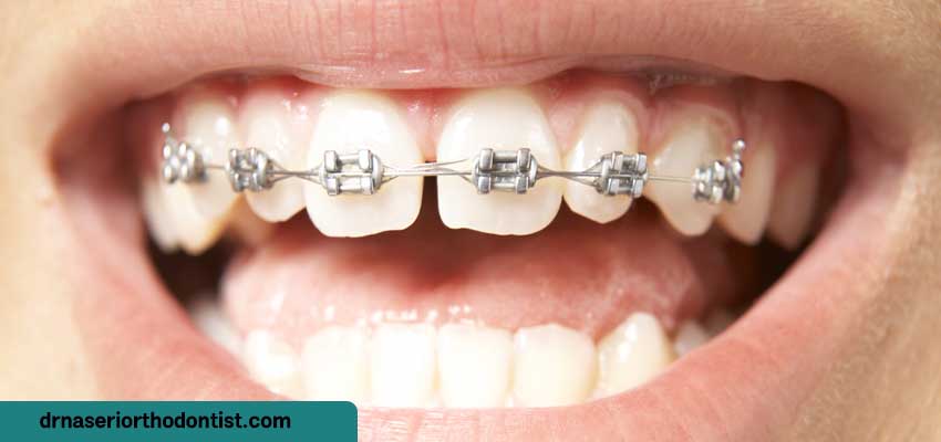آیا ارتودنسی تک دندان امکان‌پذیر است؟
