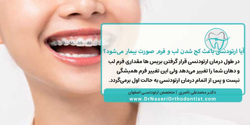 آیا ارتودنسی باعث کج شدن لب و فرم صورت بیمار می‌شود؟ | دکتر محمدعلی ناصری متخصص ارتودنسی در اصفهان