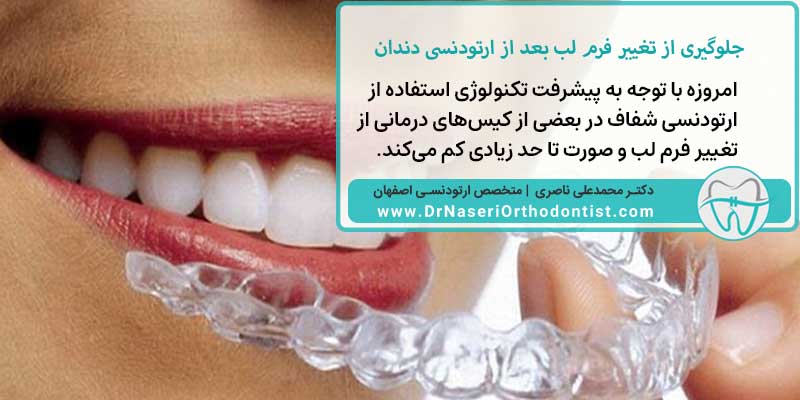 جلوگیری از تغییر فرم لب بعد از ارتودنسی دندان | دکتر محمد علی ناصری متخصص ارتودنسی اصفهان