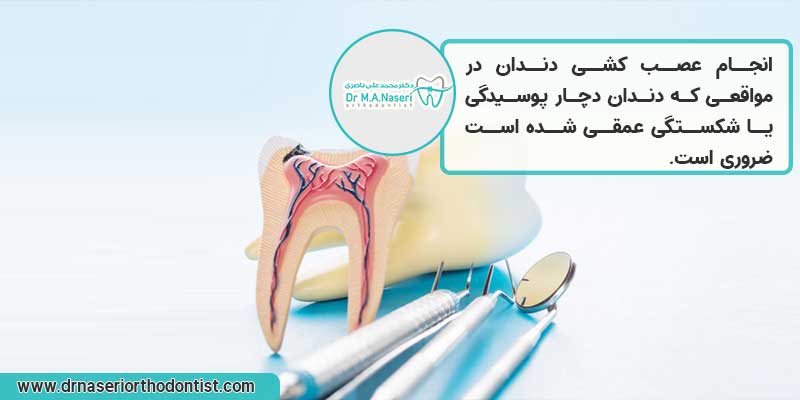 کاربرد عصب کشی دندان