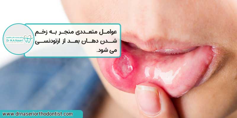 زخم شدن دهان بعد از ارتودنسی