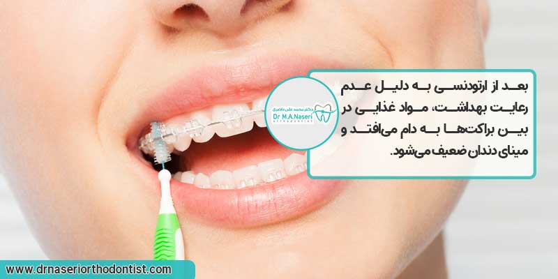 دلایل پوسیدگی دندان بعد از ارتودنسی