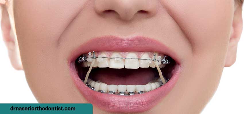 دهانشویه مناسب ارتودنسی چه مشخصاتی دارد؟ | دکتر ناصری متخصص ارتودنسی اصفهان 