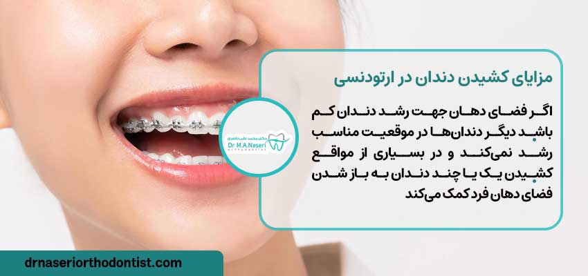 کشیدن دندان در ارتودنسی چه مزایایی دارد؟ | دکتر ناصری متخصص ارتودنسی اصفهان 