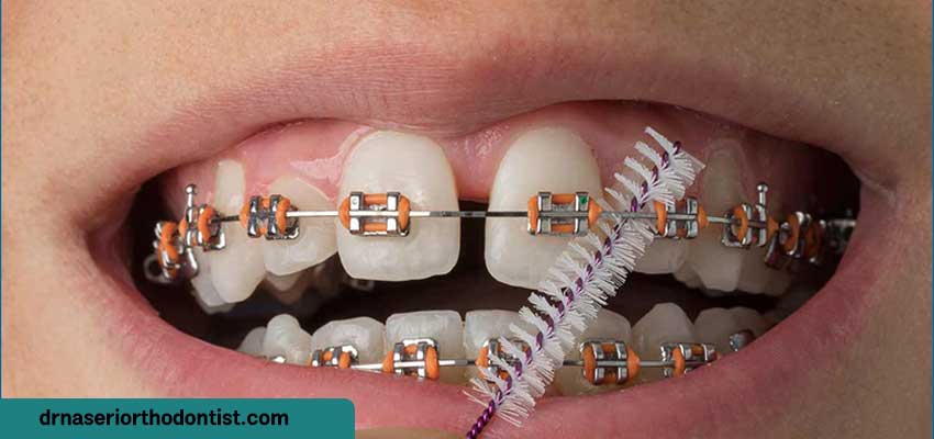 آیا شکاف و فضای خالی ایجاد شده در دهان پس از کشیدن دندان از بین می رود؟| دکتر ناصری متخصص ارتودنسی اصفهان 
