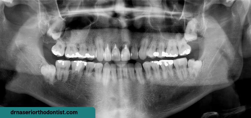 تحلیل ریشه دندان چیست؟