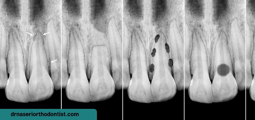 آیا برای کوتاه‌شدن ریشه دندان در حین ارتودنسی راه‌حلی وجود دارد؟