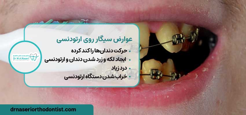 عوارض سیگار روی دندان‌های ارتودنسی شده