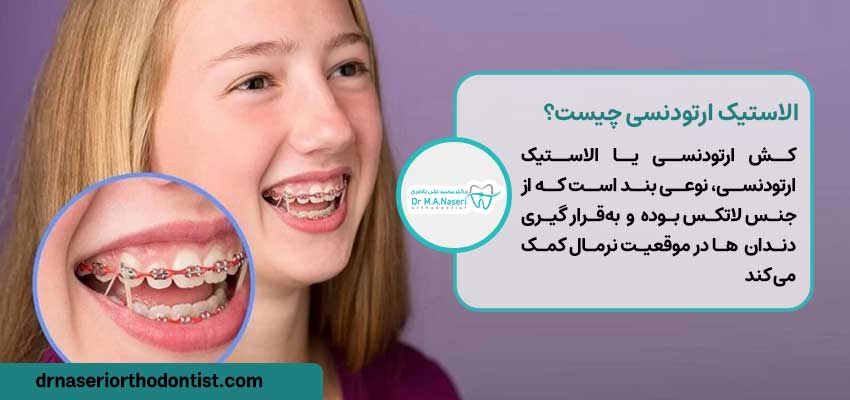 الاستیک ارتودنسی(orthodontic Elastic) چیست؟