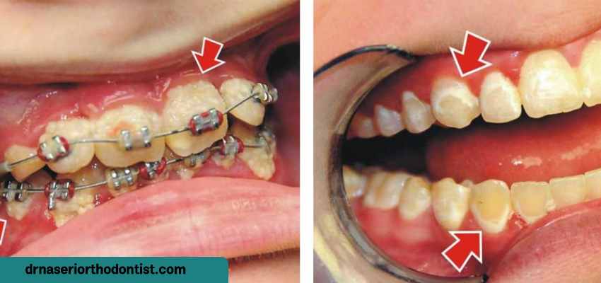 ایجاد لکه سفید روی دندان در طول ارتودنسی