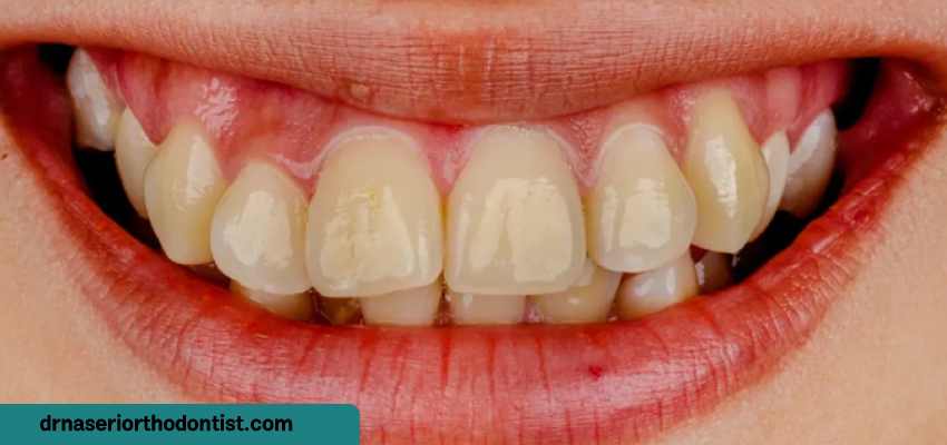 آیا لکه‌های سفید در دندان‌ها عوارض جانبی دارند؟