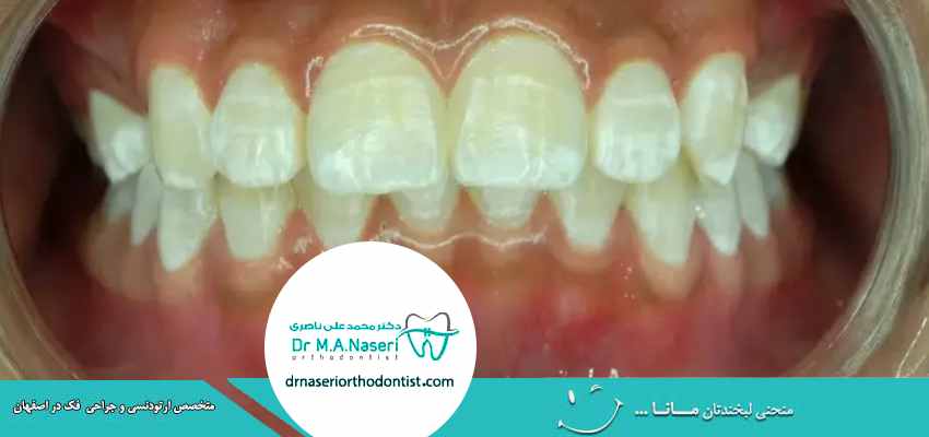 چگونه از بروز لکه‌های سفید روی دندان در زمان ارتودنسی پیشگیری کنیم؟