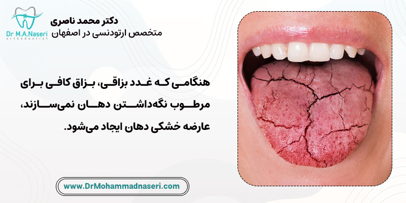 عارضه خشکی دهان به دلیل عدم بزاق کافی در دهان ایجاد می شود